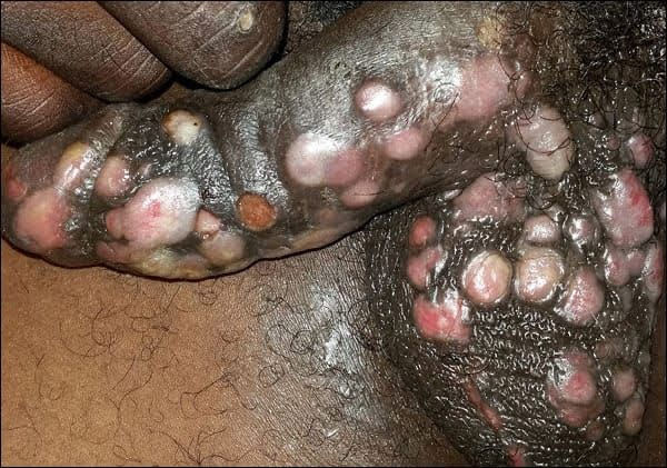 Sexually Transmitted Disease